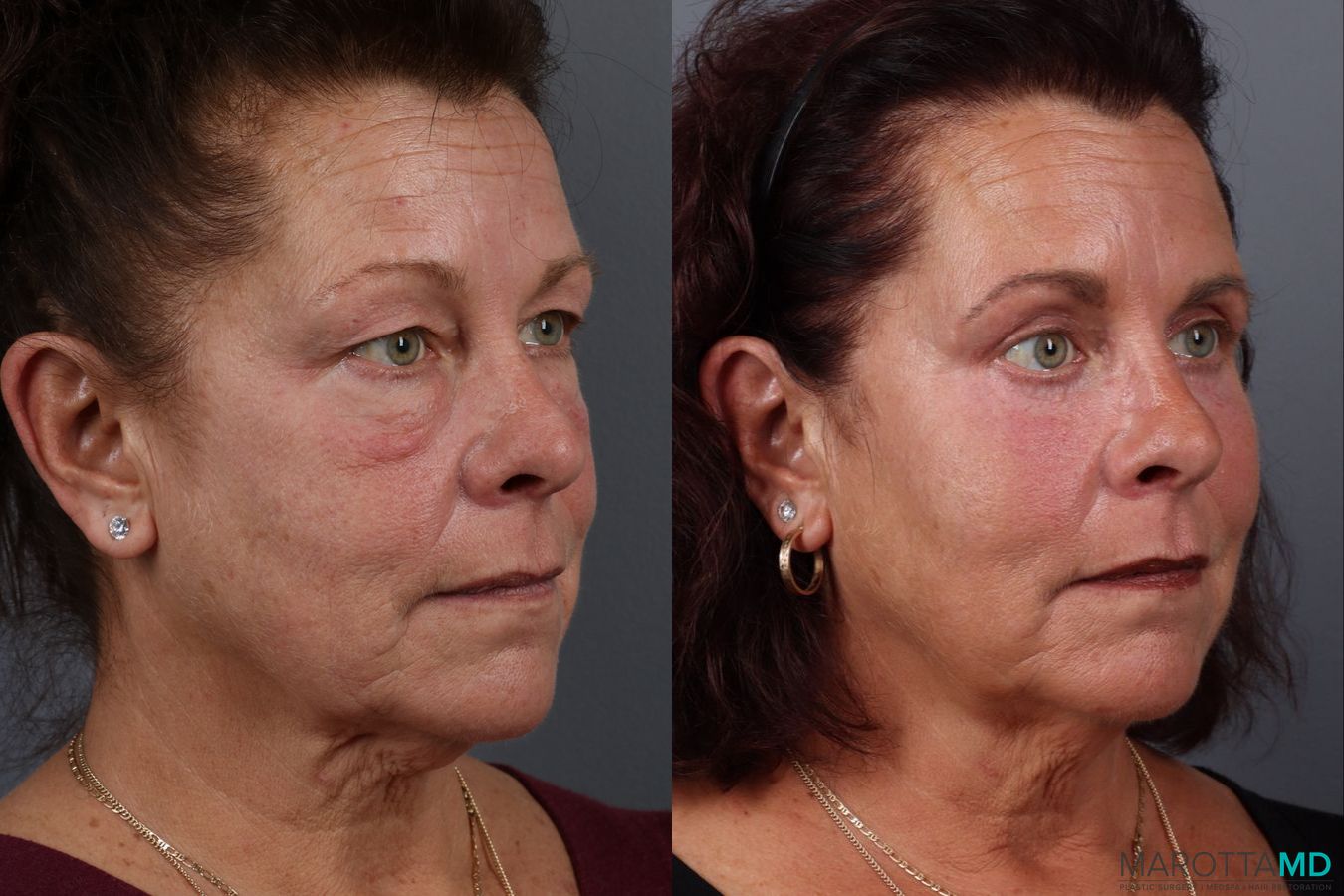 Before and after Fat Transfer - Face case 21514 - Angle 2