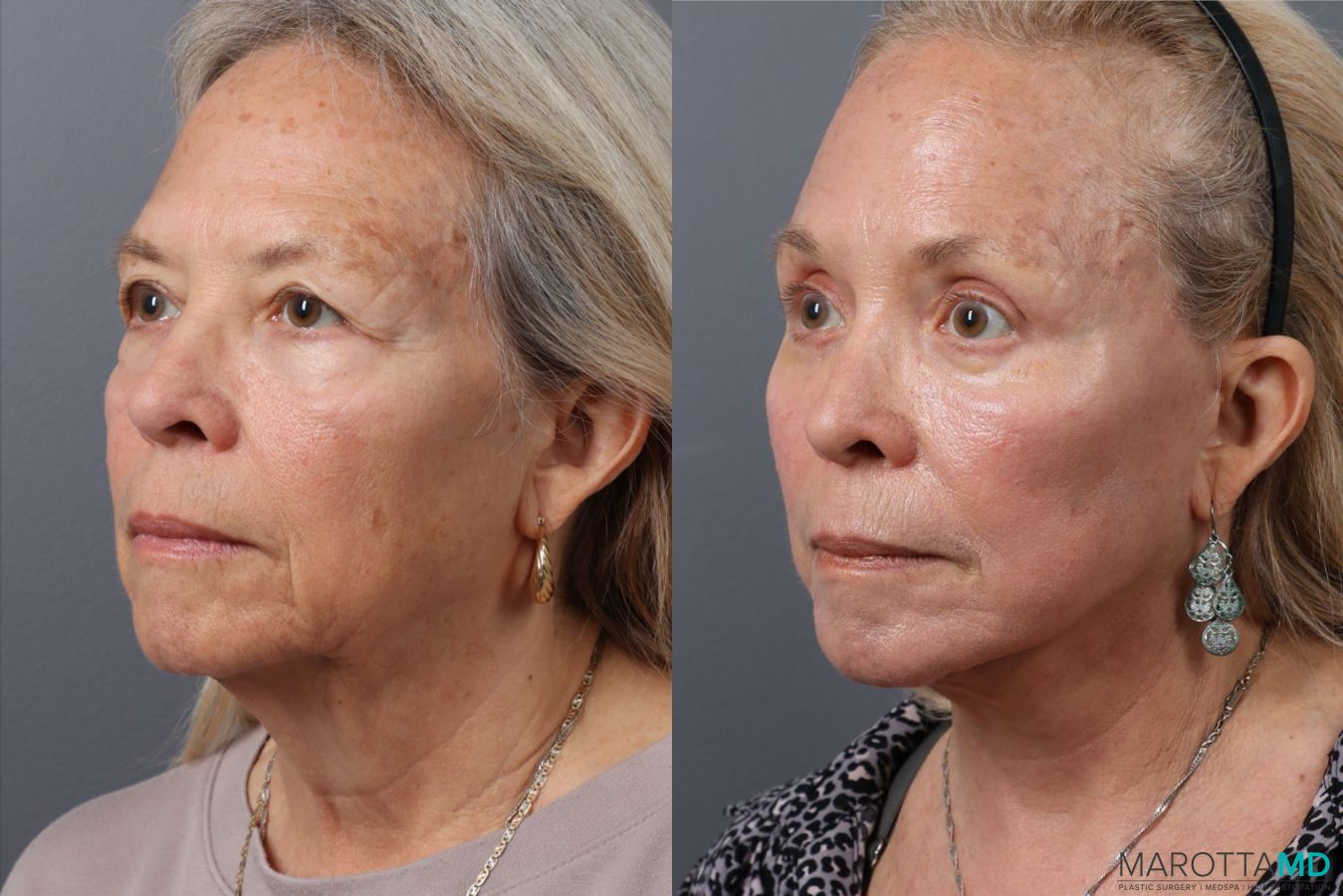 Before and after Blepharoplasty Lower case 43705 - Angle 4