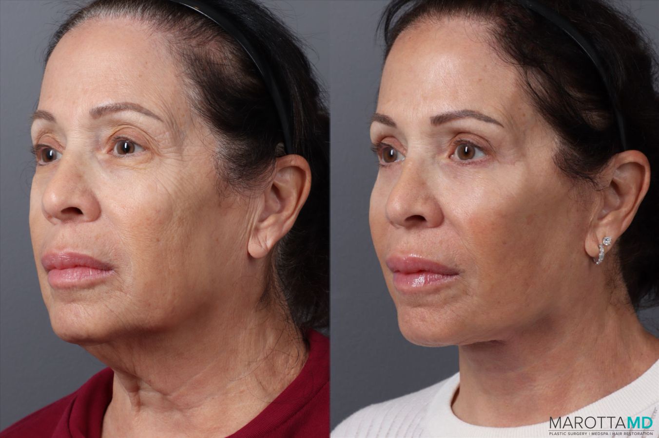 Before and after Blepharoplasty Upper case 49879 - Angle 2