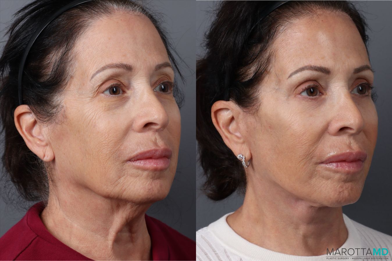 Before and after Blepharoplasty Upper case 49879 - Angle 4