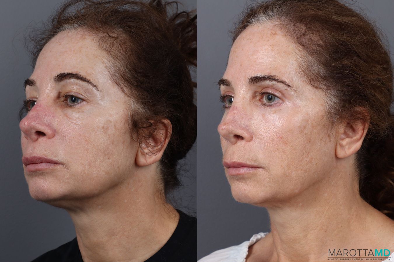Before and after Blepharoplasty Upper case 18372 - Angle 3