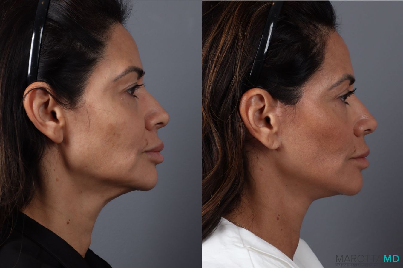Before and after Mini Facelift case 49463 - Angle 3
