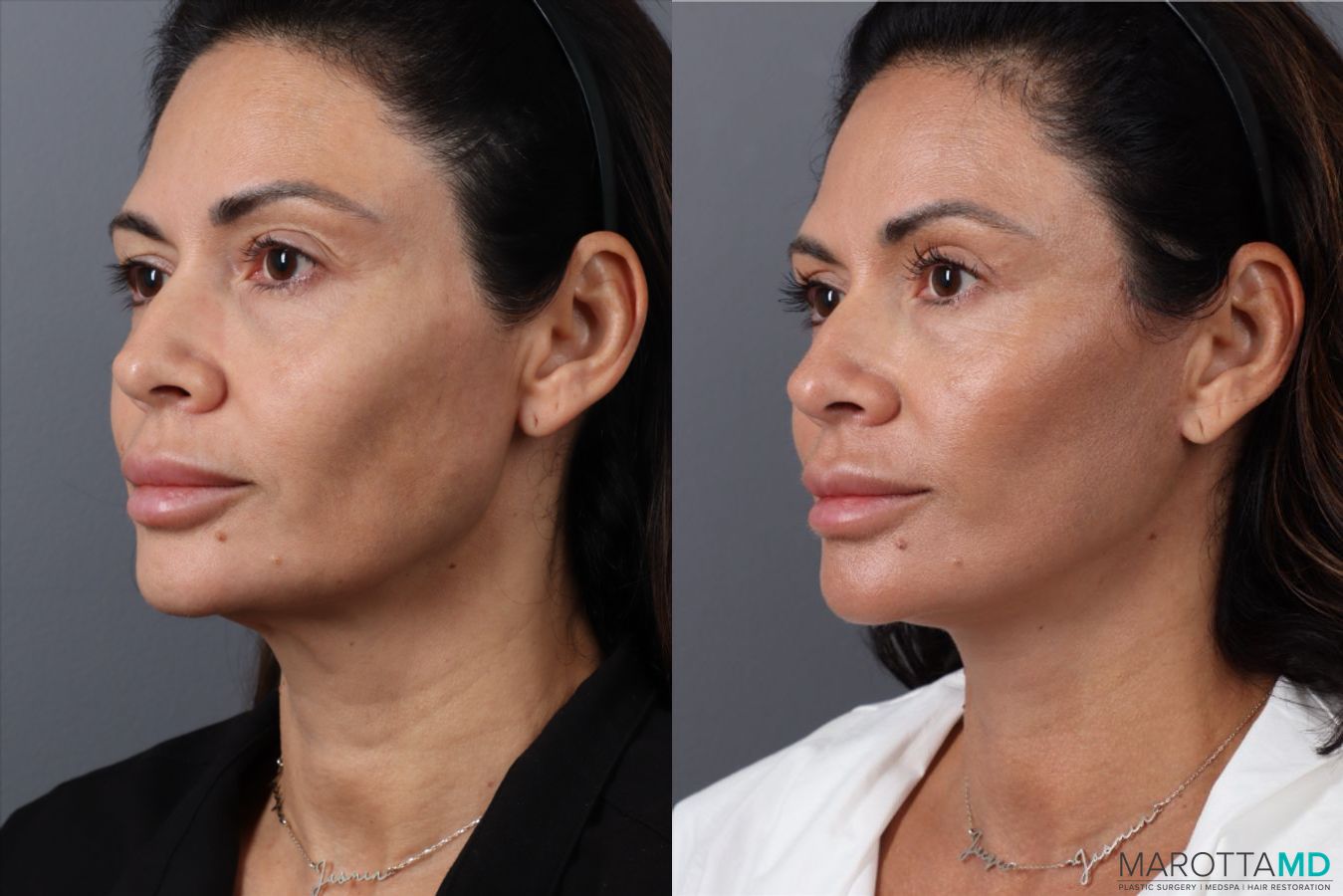 Before and after Mini Facelift case 49463 - Angle 4
