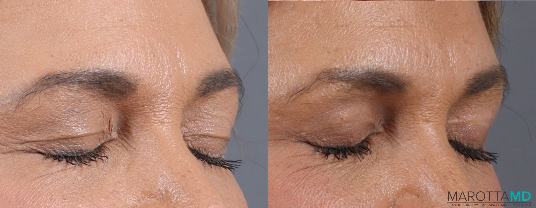 Before and after Blepharoplasty Upper case 7090 - Angle 6