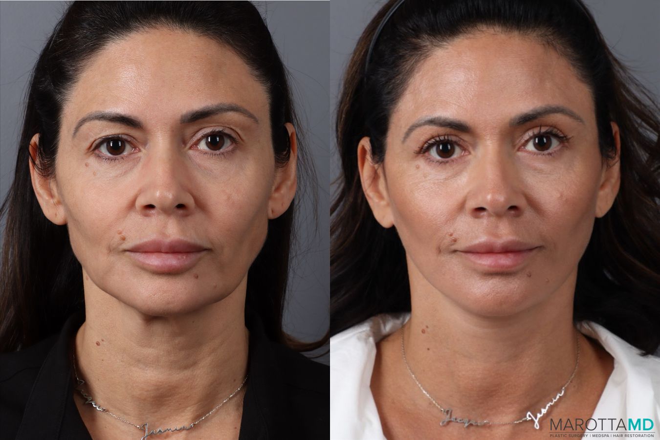 Before and after Mini Facelift case 49463