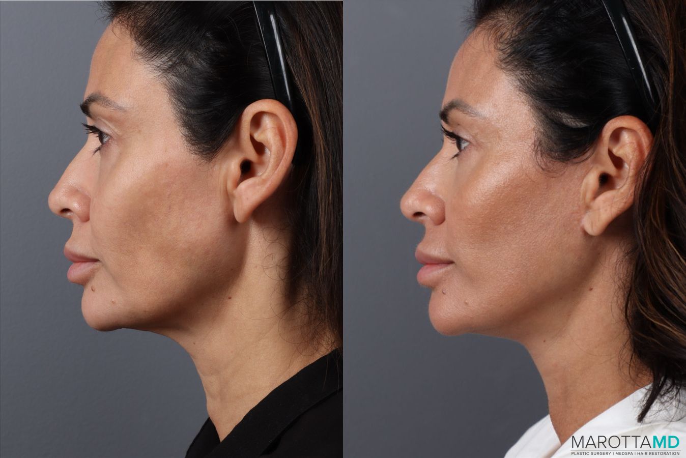 Before and after Mini Facelift case 49463 - Angle 5
