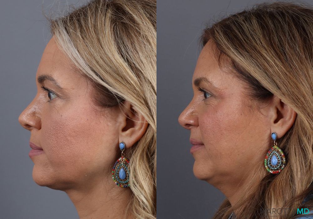 Before and after Blepharoplasty Upper case 7090 - Angle 3