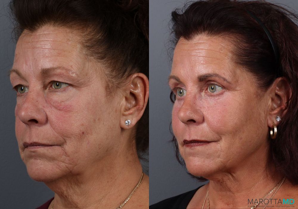 Fat Transfer - Face - Thumbnail 3