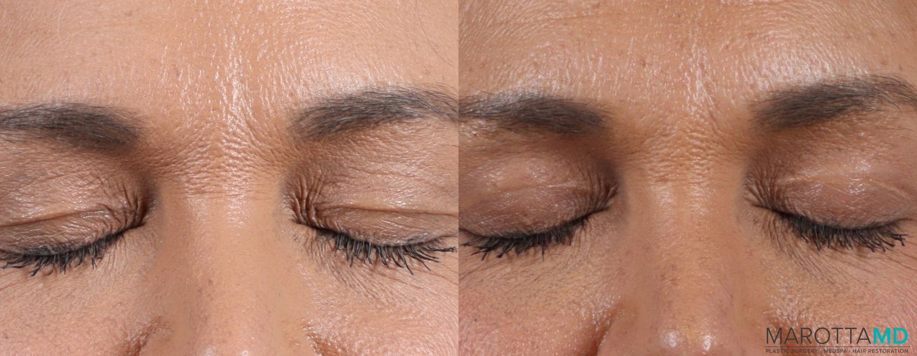 Before and after Blepharoplasty Upper case 7090 - Angle 7