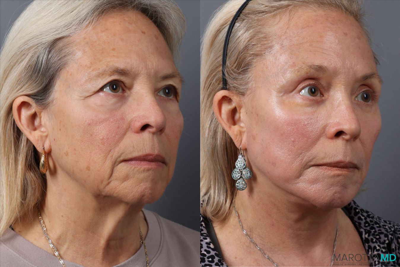 Before and after Blepharoplasty Lower case 43705 - Angle 2