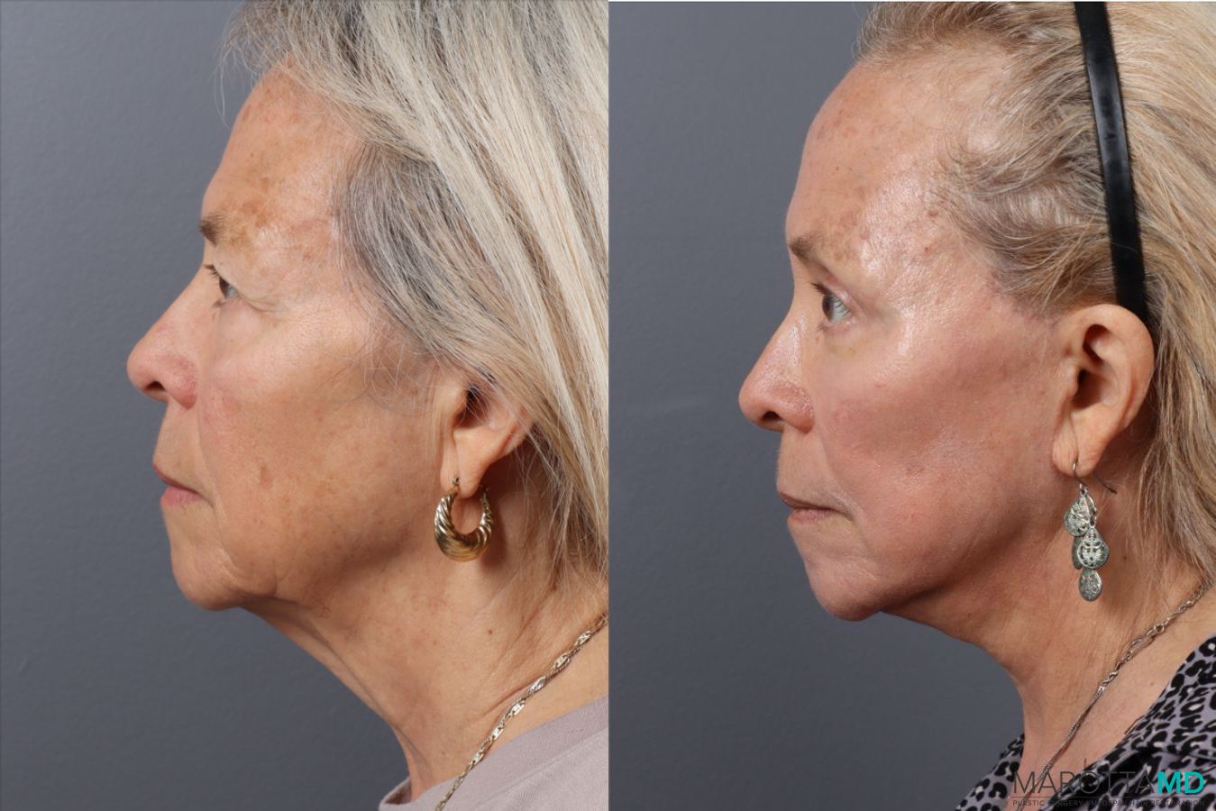 Before and after Blepharoplasty Lower case 43705 - Angle 5