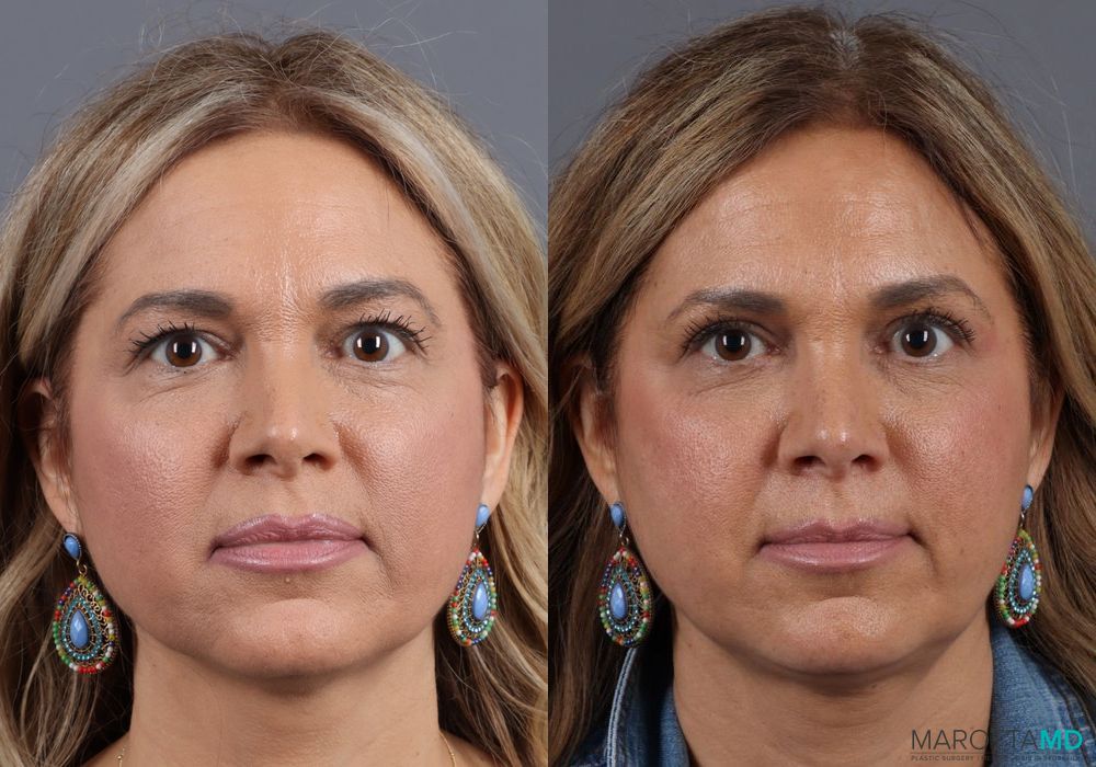 Before and after Blepharoplasty Upper case 7090