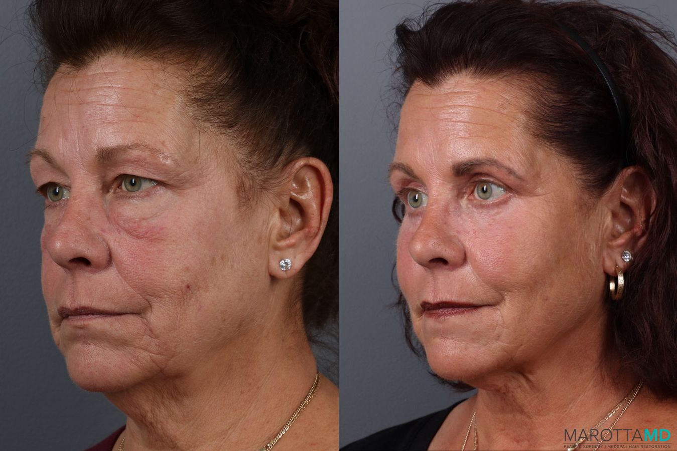 Before and after Fat Transfer - Face case 21514 - Angle 3