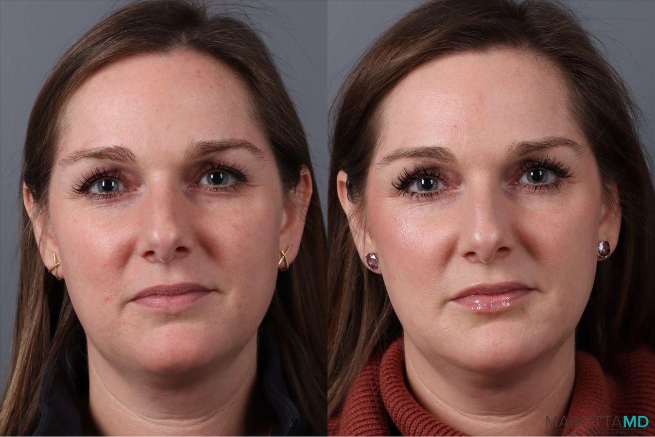 Before and after Botox - Chin case 41875