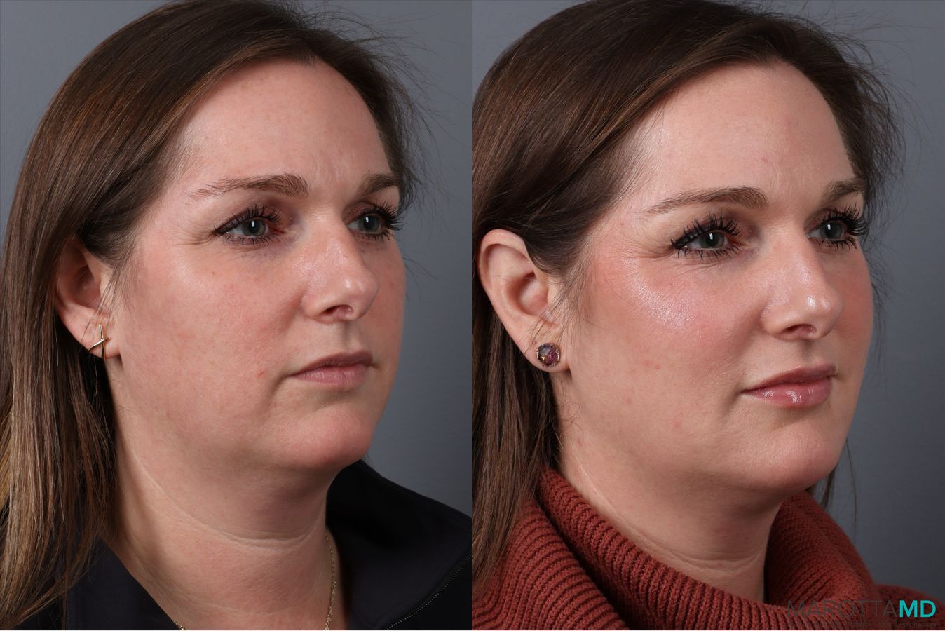 Before and after Botox - Chin case 41875 - Angle 2