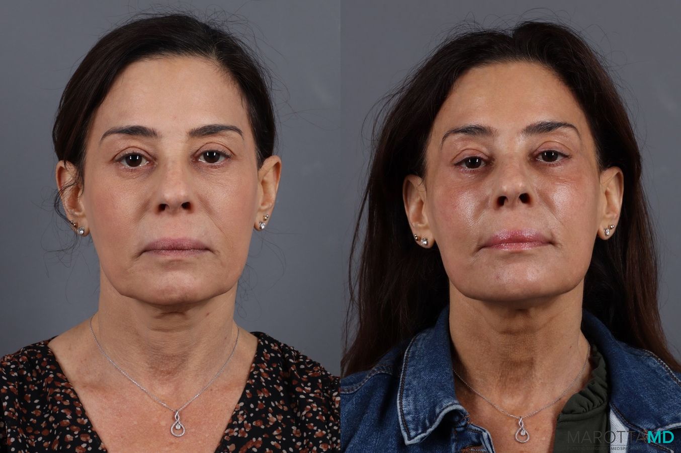 Before and after Botox - Chin case 7292