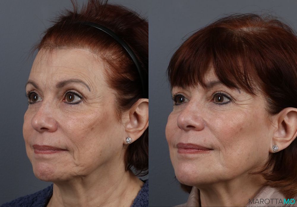 Botox - Chin - Thumbnail 5