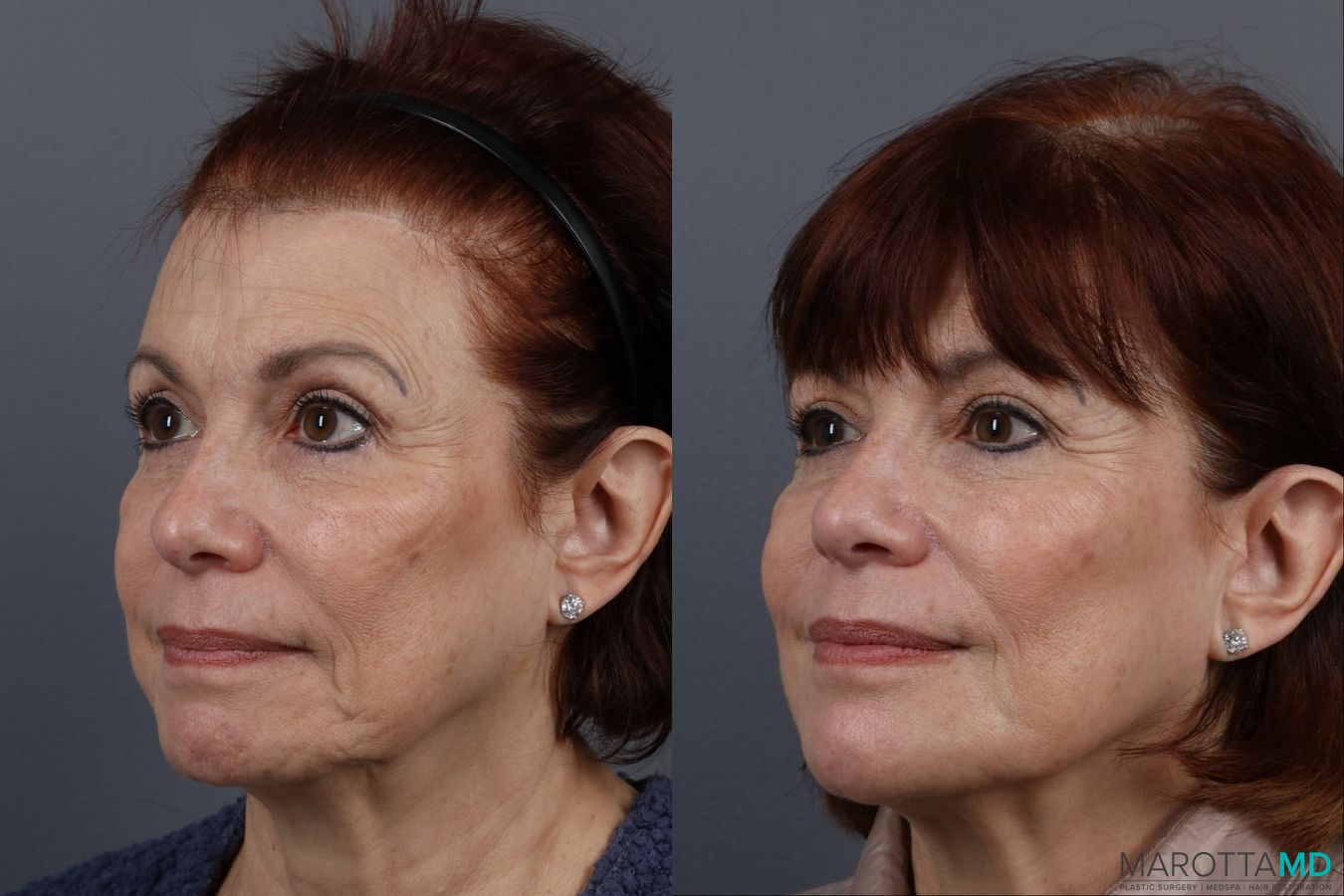 Before and after Botox - Chin case 7149 - Angle 5
