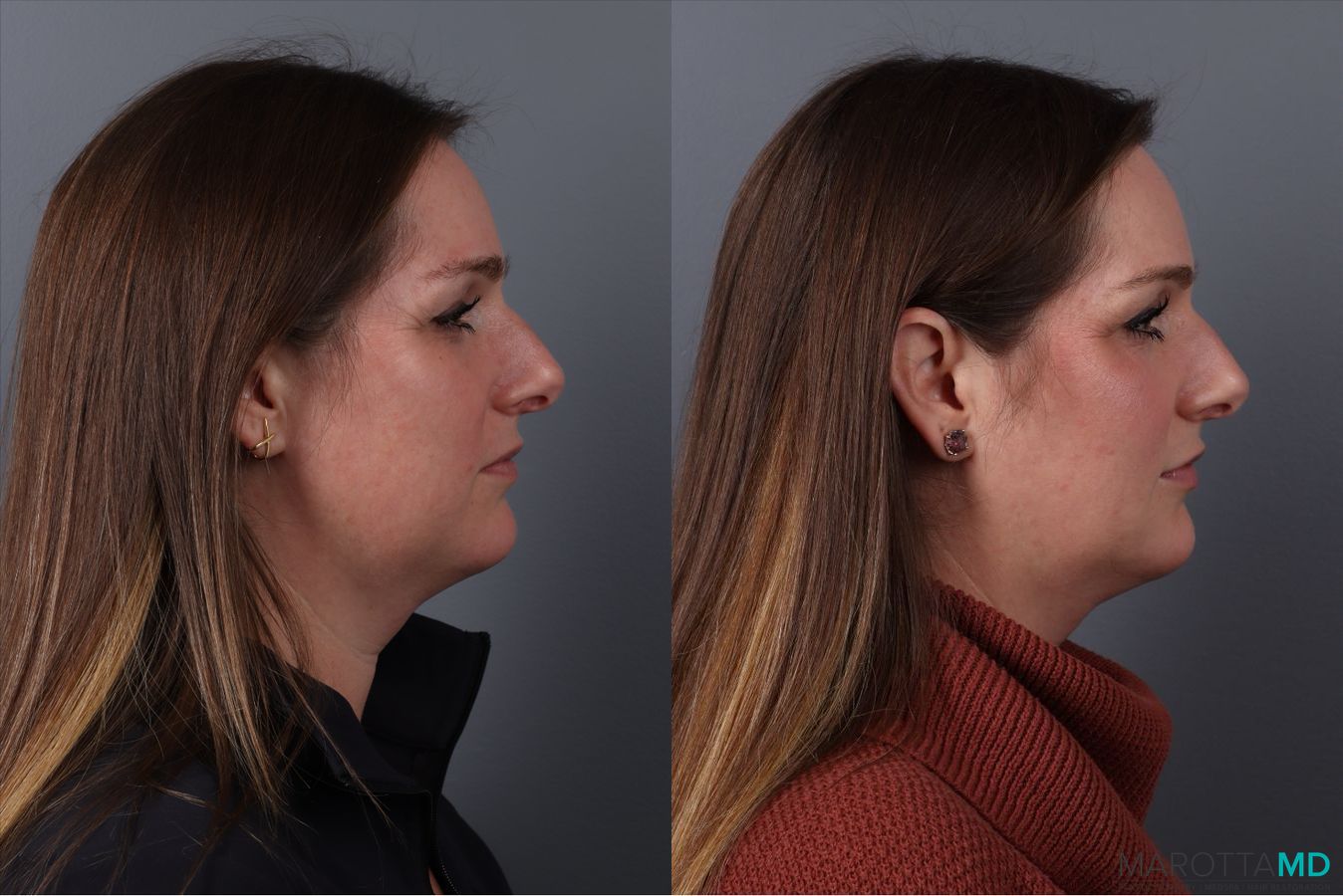 Before and after Botox - Chin case 41875 - Angle 3