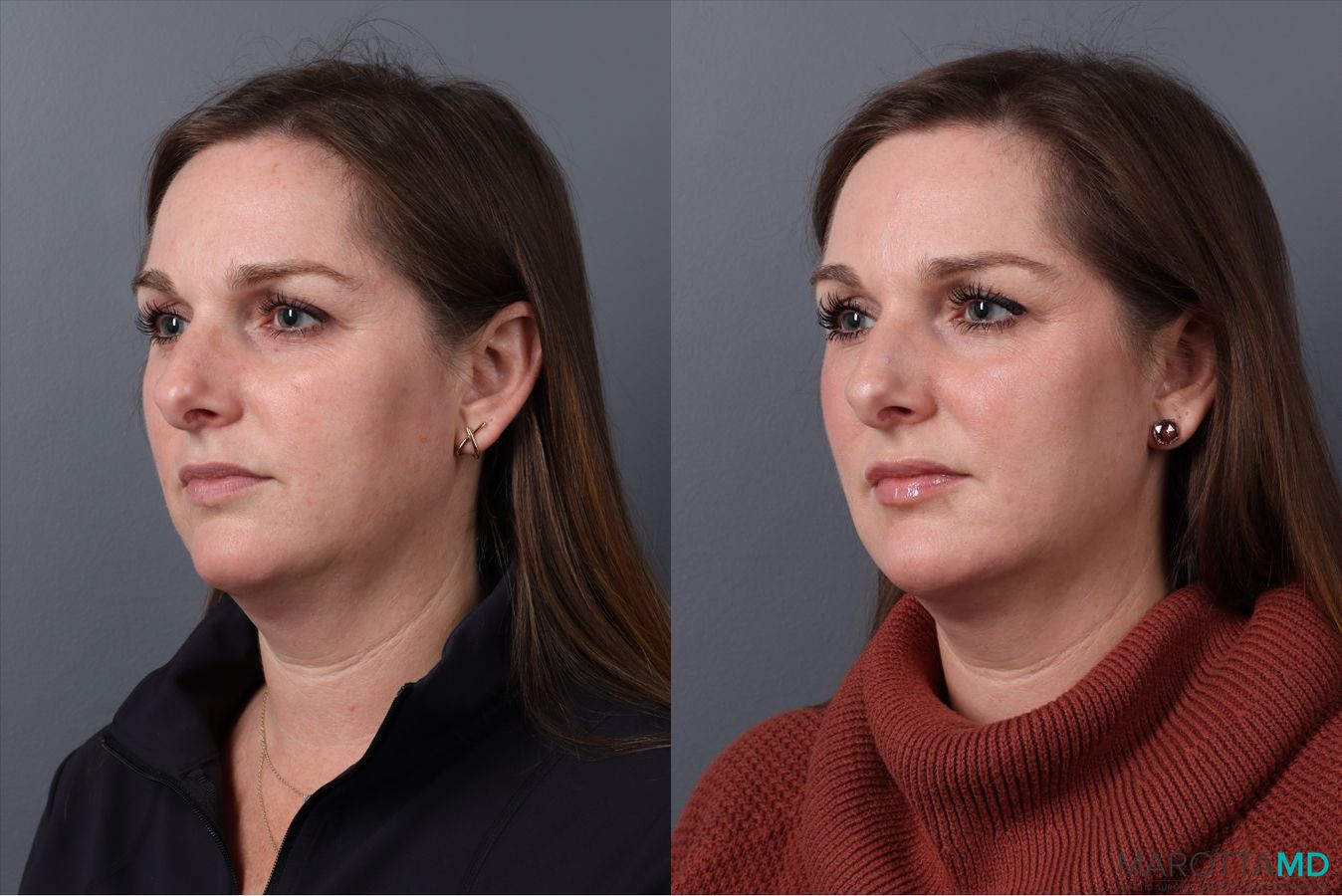 Before and after Botox - Chin case 41875 - Angle 4