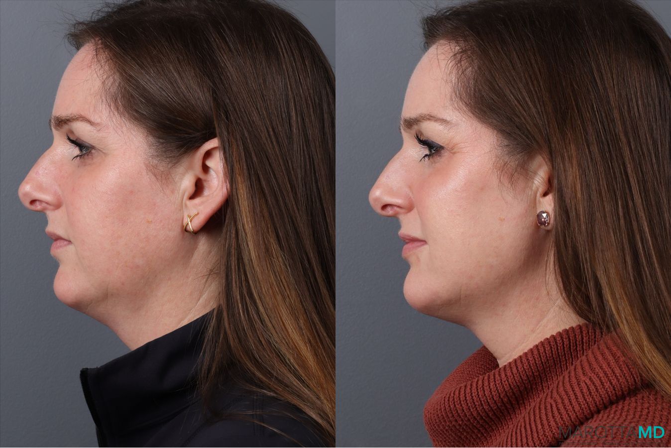 Before and after Botox - Chin case 41875 - Angle 5