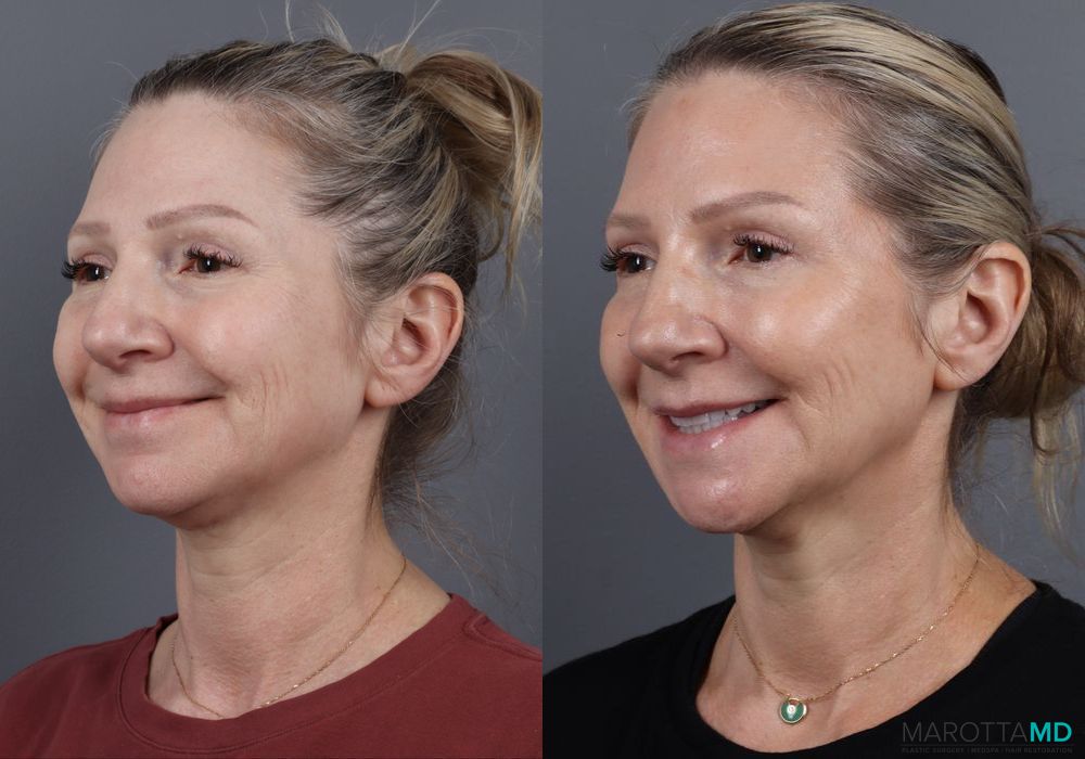 Botox - Forehead - Thumbnail 5