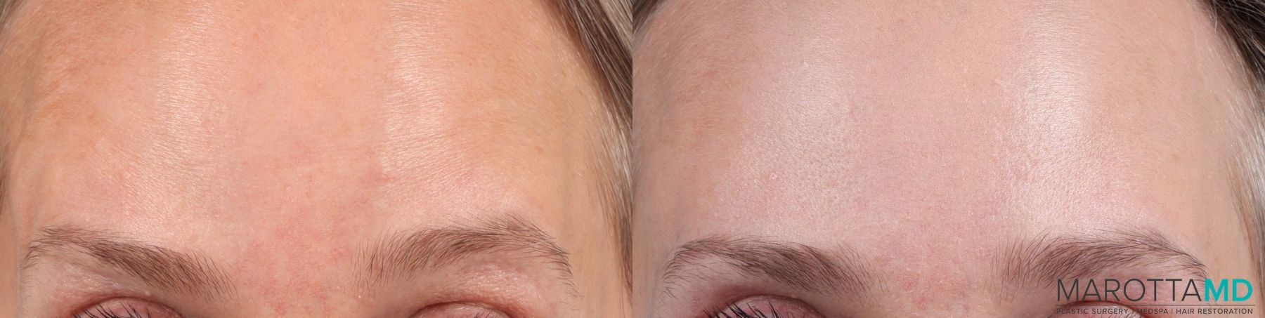 Before and after Botox - Crow's Feet case 7173 - Angle 2