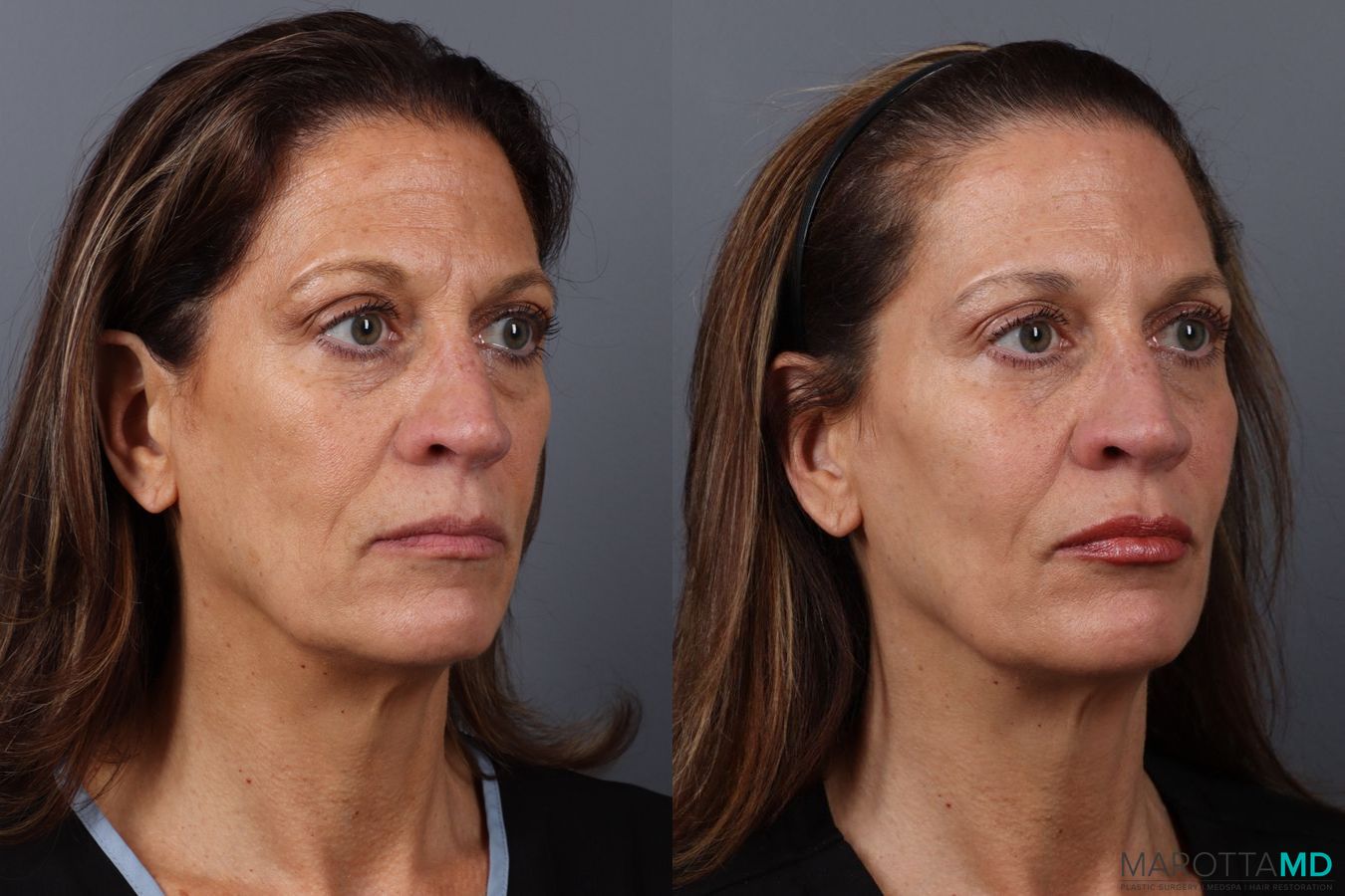 Before and after Botox - Forehead case 21531 - Angle 3