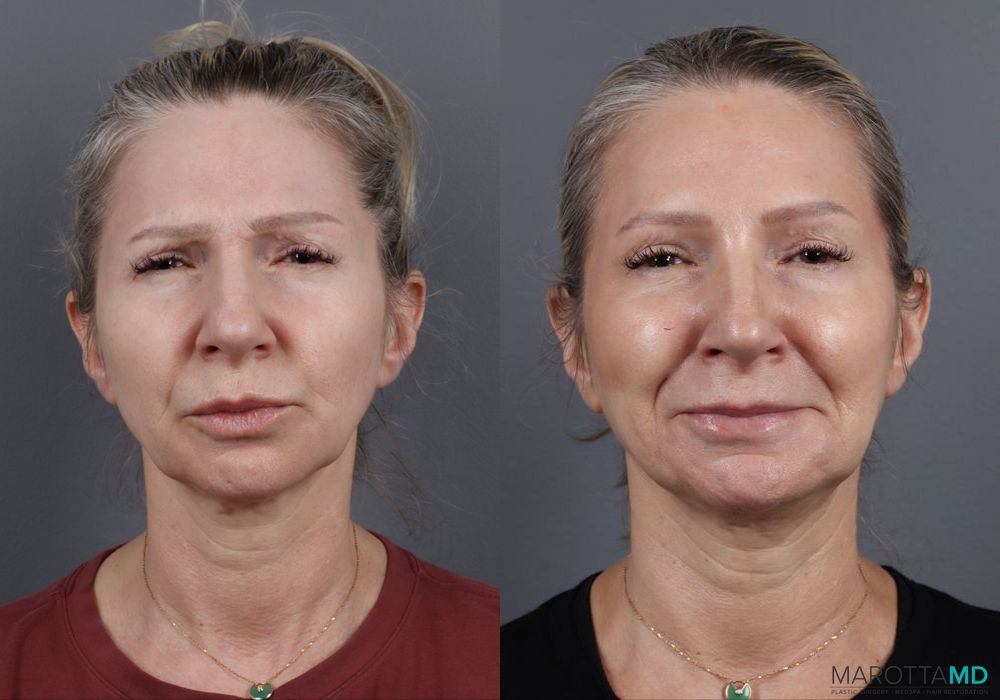 Botox - Forehead - Thumbnail 3