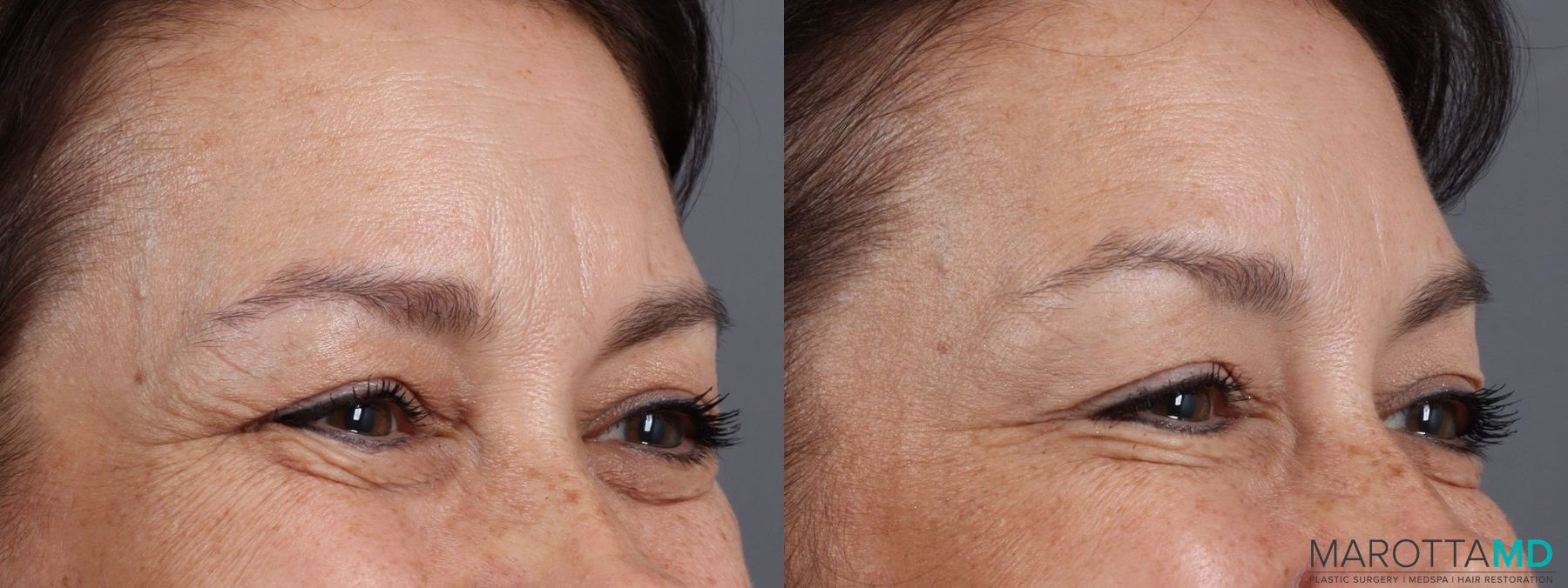 Before and after Botox - Crow's Feet case 7183 - Angle 3