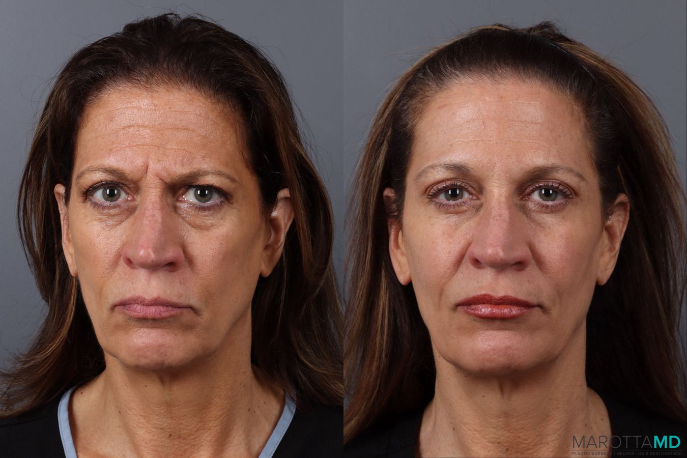 Before and after Botox - Forehead case 21531 - Angle 2