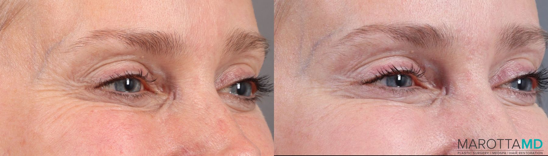 Before and after Botox - Crow's Feet case 7173 - Angle 4