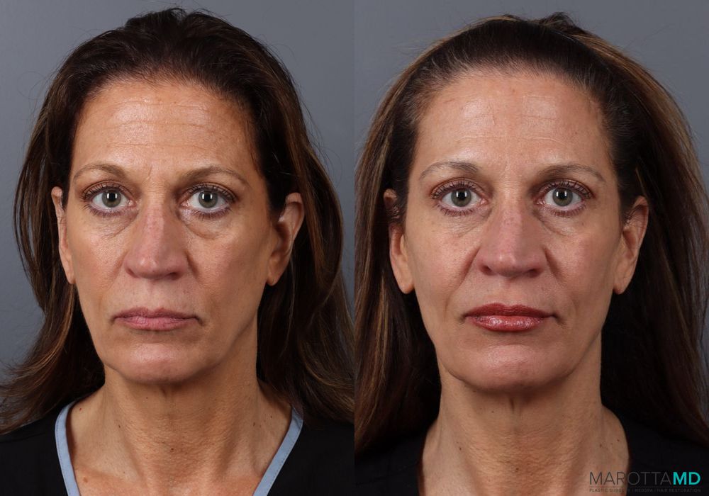 Botox - Forehead - Case 1159