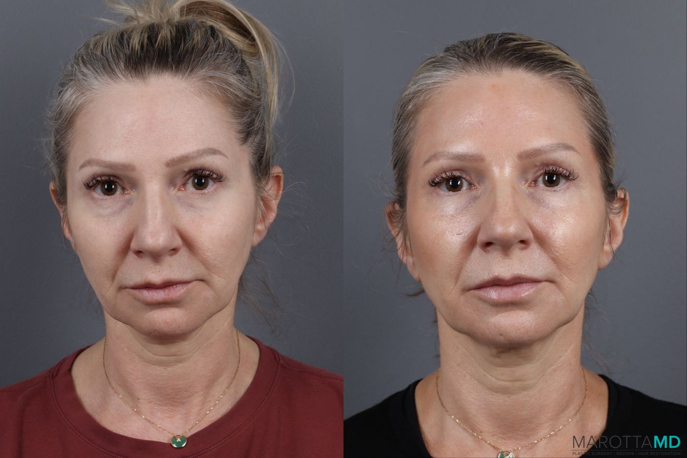 Before and after Botox - Forehead case 14129