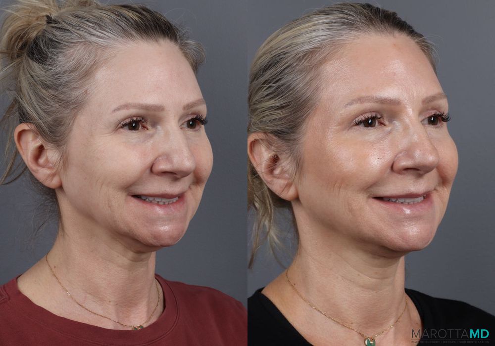 Botox - Forehead - Thumbnail 4