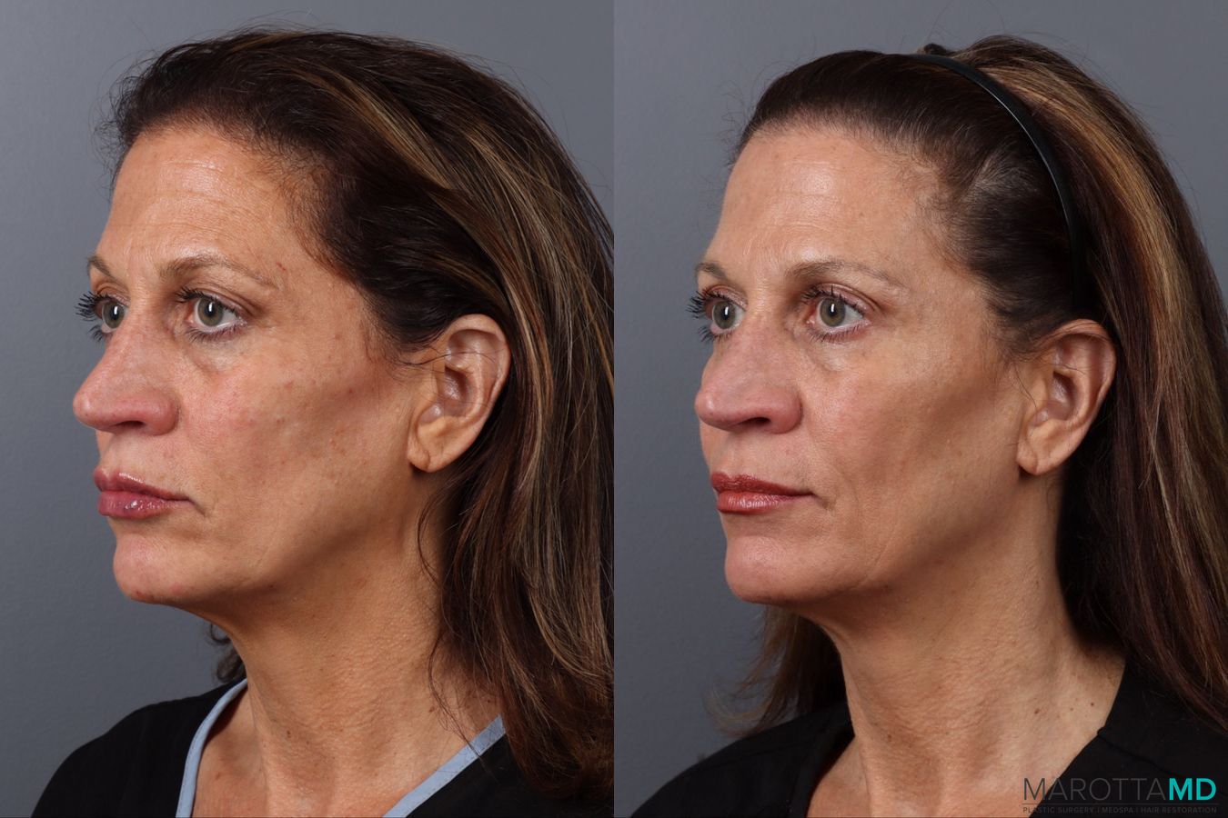 Before and after Botox - Forehead case 21531 - Angle 4