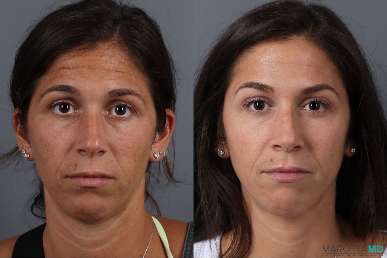 Before and after BOTOX® Cosmetic case 41873