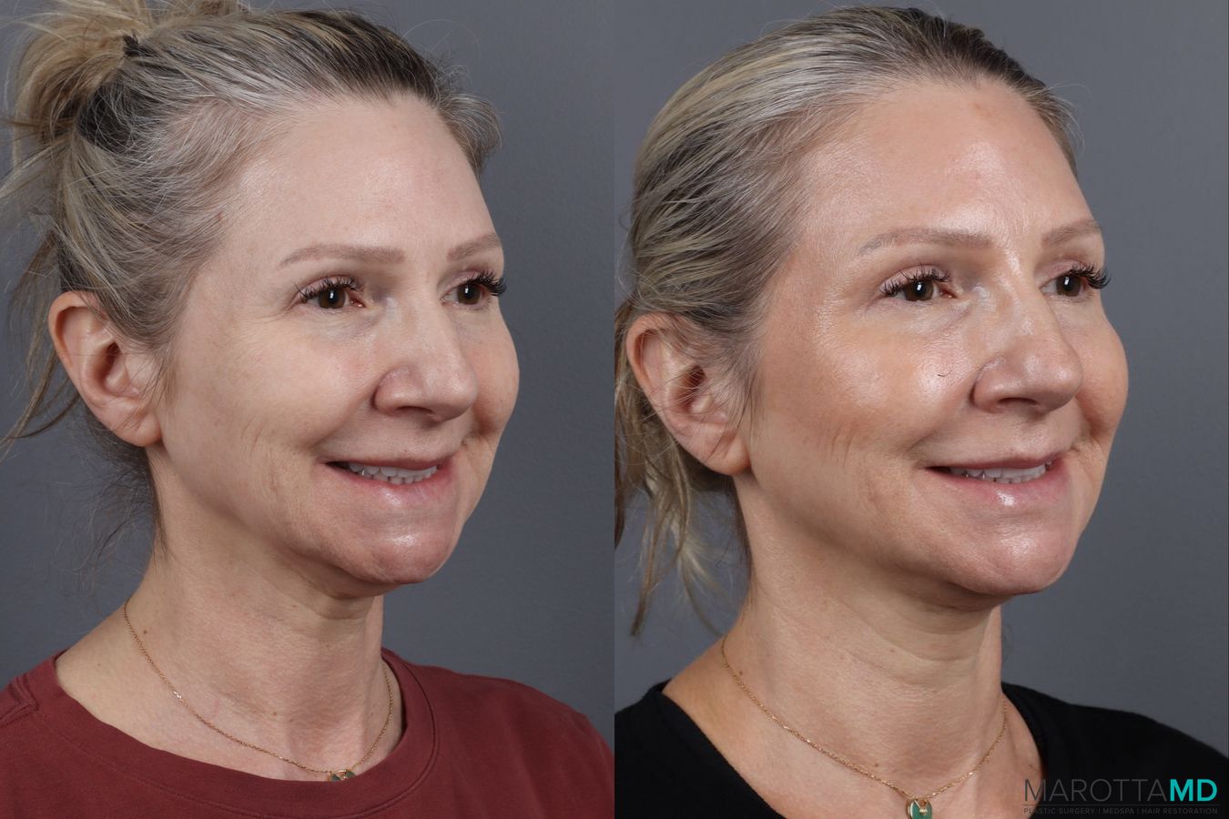 Before and after Botox - Forehead case 14129 - Angle 4