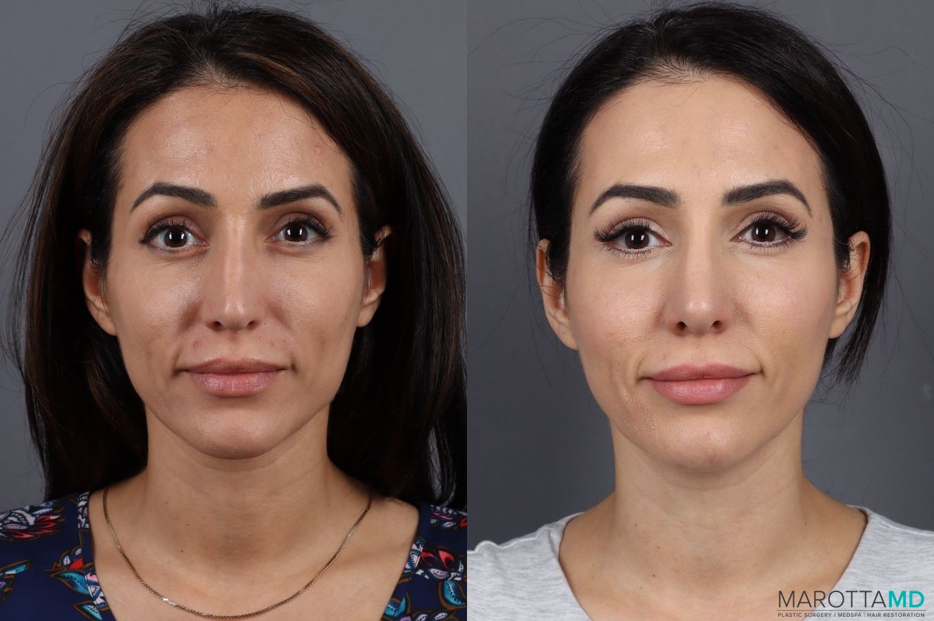 Before and after Botox - Crow's Feet case 7192