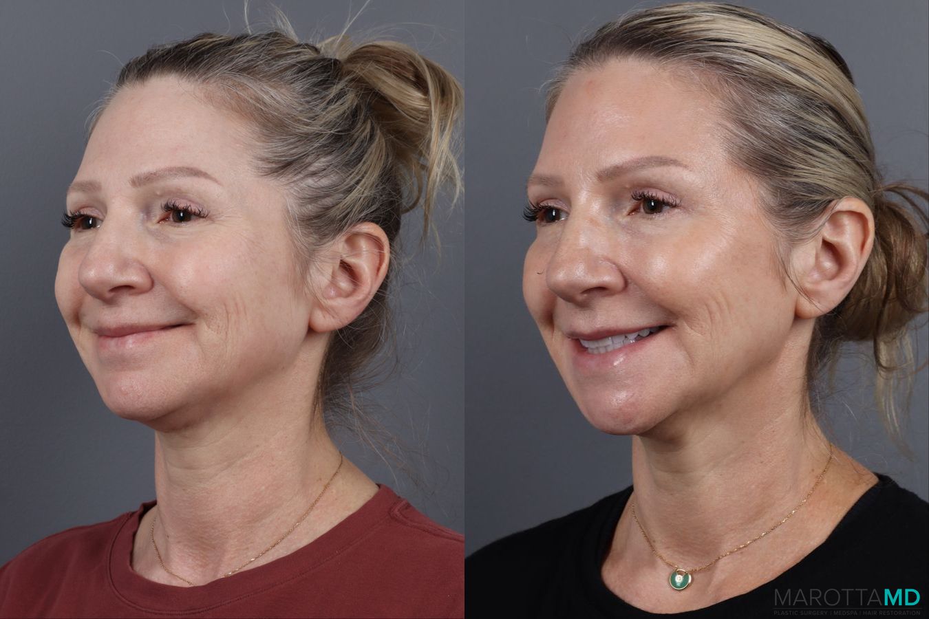 Before and after Botox - Forehead case 14129 - Angle 5