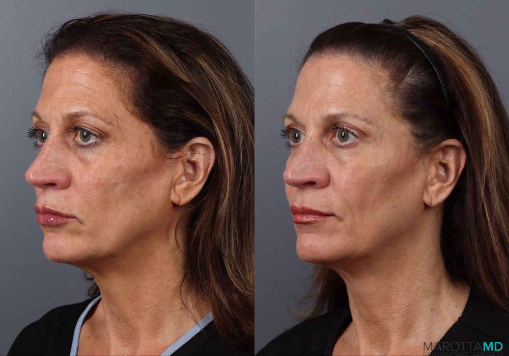 Botox - Crow's Feet - Thumbnail 4