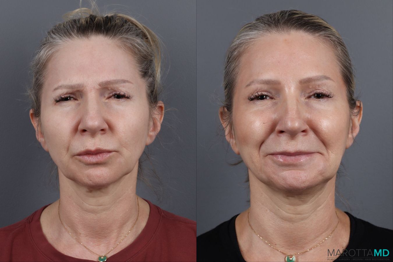 Before and after Botox - Forehead case 14129 - Angle 3