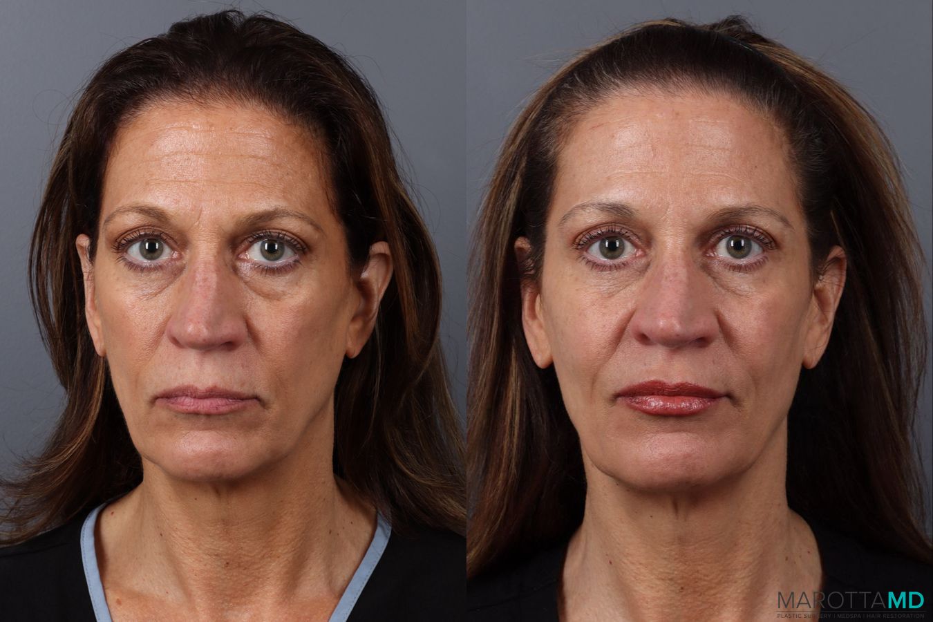 Before and after Botox - Forehead case 21531