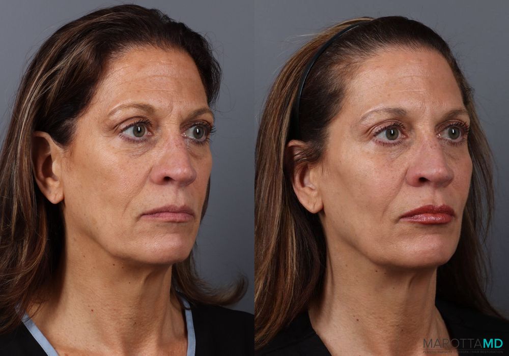 Botox - Forehead - Thumbnail 3