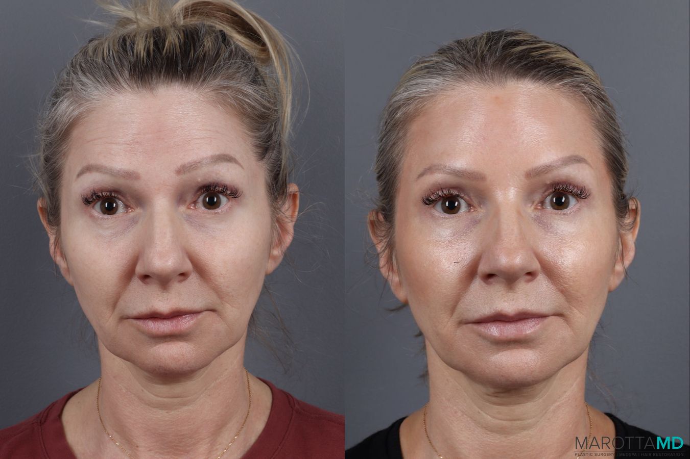 Before and after Botox - Forehead case 14129 - Angle 2
