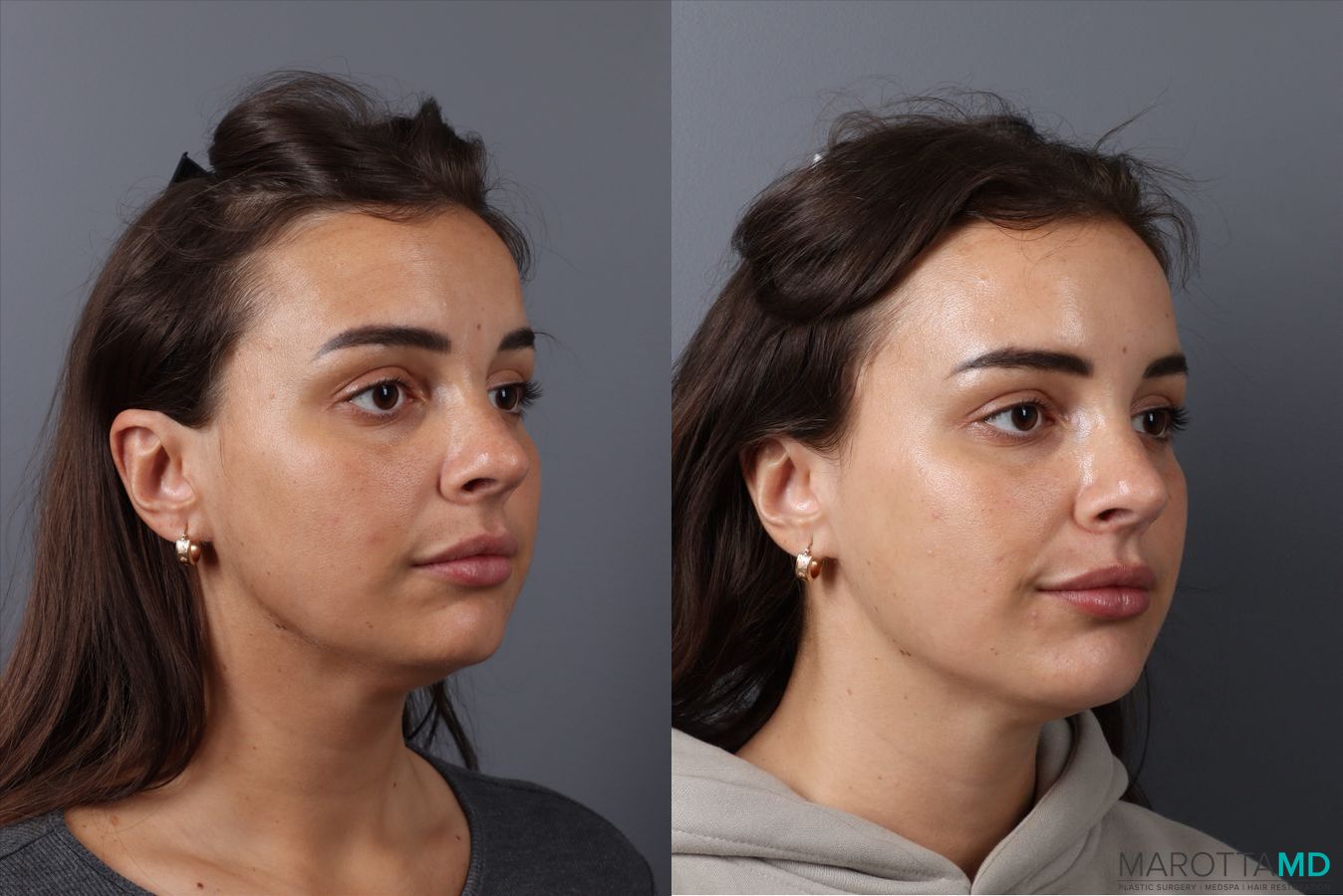 Before and after Botox - DAO case 41870 - Angle 2