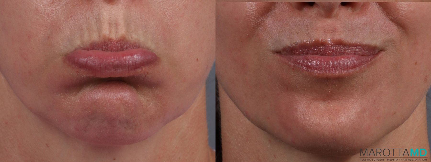 Before and after Botox - DAO case 7161