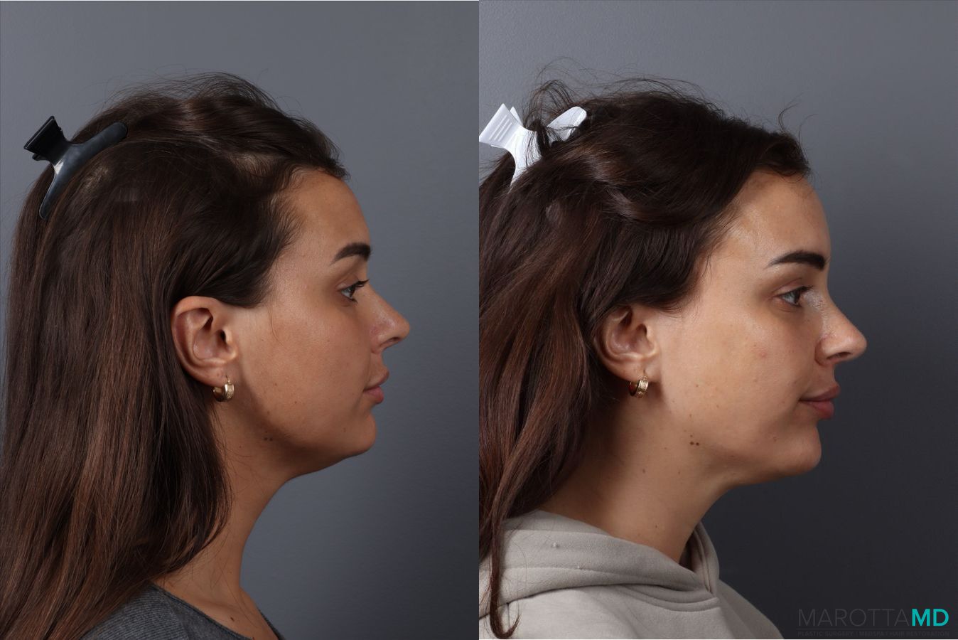 Before and after Botox - DAO case 41870 - Angle 3