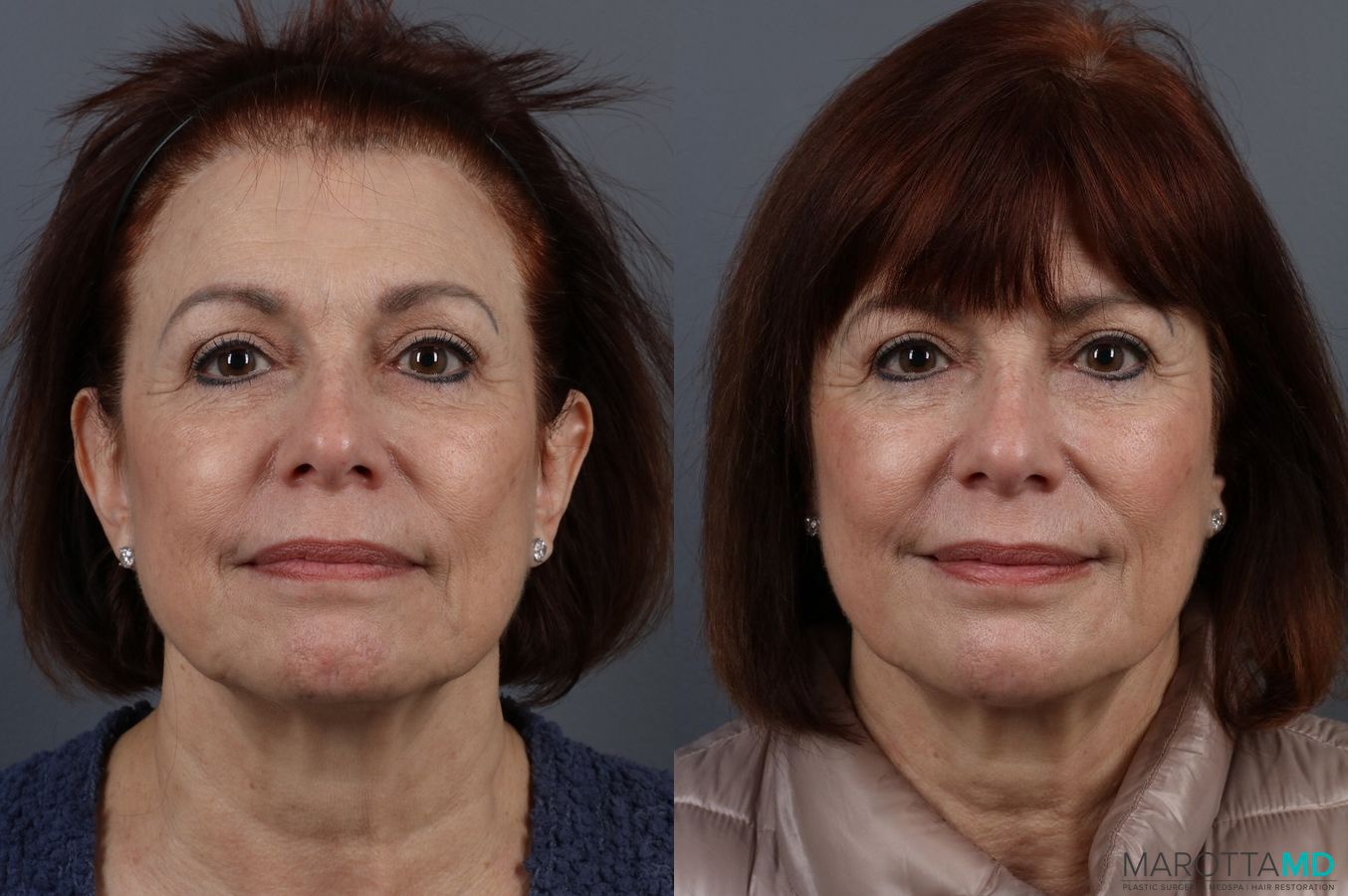 Before and after Botox - DAO case 7148