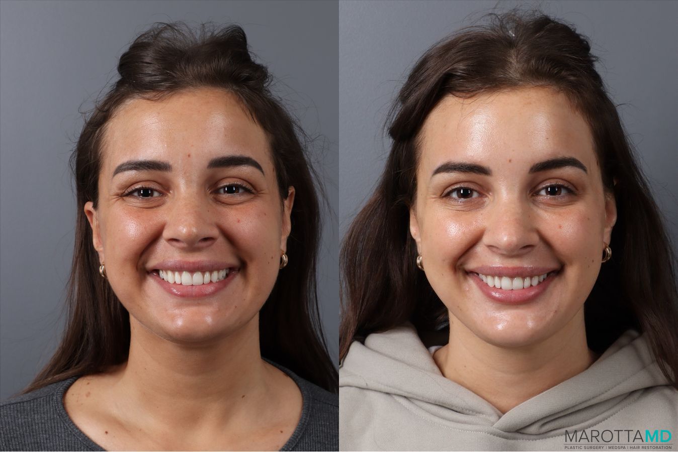 Before and after Botox - DAO case 41870